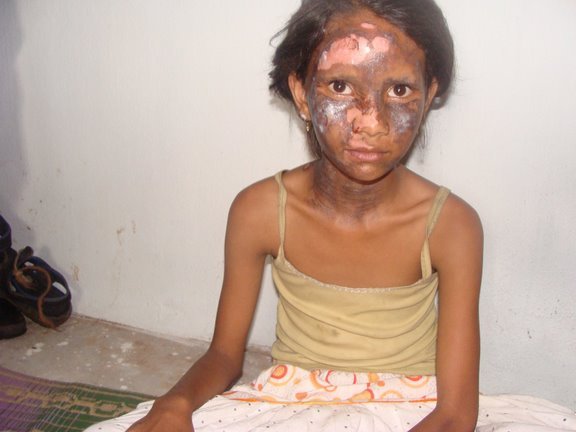 Kandhamal Violence -5 Years Later